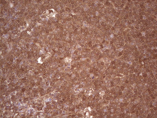LGALS9 / Galectin 9 Antibody - Immunohistochemical staining of paraffin-embedded Human lymphoma tissue using anti-LGALS9 mouse monoclonal antibody. (Heat-induced epitope retrieval by 1 mM EDTA in 10mM Tris, pH8.5, 120C for 3min,