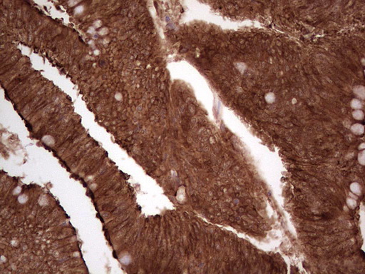 LGALS9 / Galectin 9 Antibody - IHC of paraffin-embedded Adenocarcinoma of Human colon tissue using anti-LGALS9 mouse monoclonal antibody. (Heat-induced epitope retrieval by 1 mM EDTA in 10mM Tris, pH8.5, 120°C for 3min).