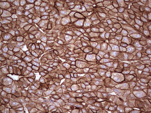 LGALS9 / Galectin 9 Antibody - IHC of paraffin-embedded Carcinoma of Human liver tissue using anti-LGALS9 mouse monoclonal antibody. (Heat-induced epitope retrieval by 1 mM EDTA in 10mM Tris, pH8.5, 120°C for 3min).