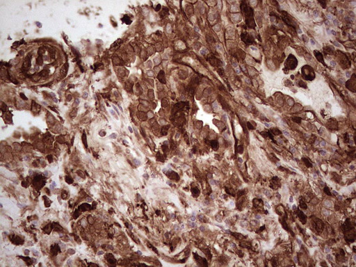 LGALS9 / Galectin 9 Antibody - IHC of paraffin-embedded Carcinoma of Human lung tissue using anti-LGALS9 mouse monoclonal antibody. (Heat-induced epitope retrieval by 1 mM EDTA in 10mM Tris, pH8.5, 120°C for 3min).