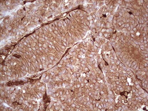 LGALS9 / Galectin 9 Antibody - IHC of paraffin-embedded Carcinoma of Human thyroid tissue using anti-LGALS9 mouse monoclonal antibody. (Heat-induced epitope retrieval by 1 mM EDTA in 10mM Tris, pH8.5, 120°C for 3min).