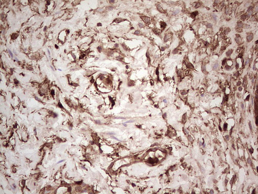 LGALS9 / Galectin 9 Antibody - IHC of paraffin-embedded Carcinoma of Human bladder tissue using anti-LGALS9 mouse monoclonal antibody. (Heat-induced epitope retrieval by 1 mM EDTA in 10mM Tris, pH8.5, 120°C for 3min).
