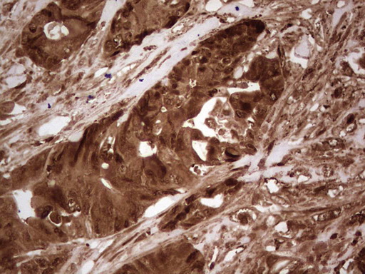 LGALS9 / Galectin 9 Antibody - Immunohistochemical staining of paraffin-embedded Adenocarcinoma of Human colon tissue using anti-LGALS9 mouse monoclonal antibody. (Heat-induced epitope retrieval by 1 mM EDTA in 10mM Tris, pH8.5, 120C for 3min,
