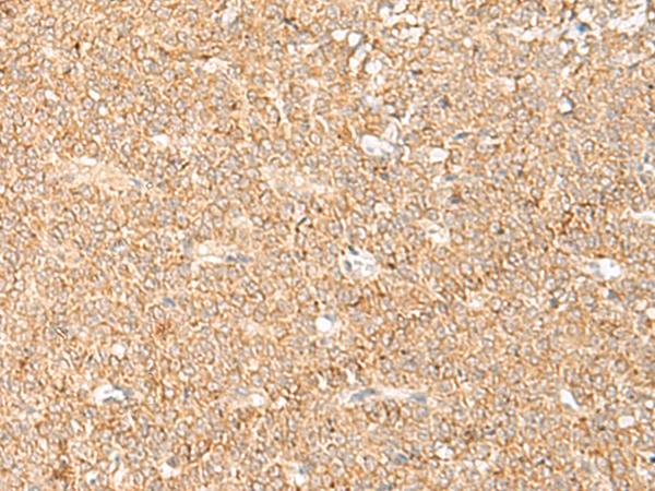 LGALSL / Galectin 5 Antibody - Immunohistochemistry of paraffin-embedded Human ovarian cancer tissue  using LGALSL Polyclonal Antibody at dilution of 1:70(×200)