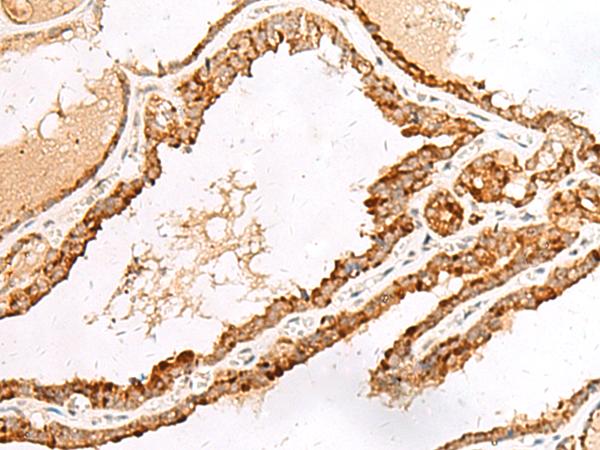 LGALSL / Galectin 5 Antibody - Immunohistochemistry of paraffin-embedded Human thyroid cancer tissue  using LGALSL Polyclonal Antibody at dilution of 1:70(×200)