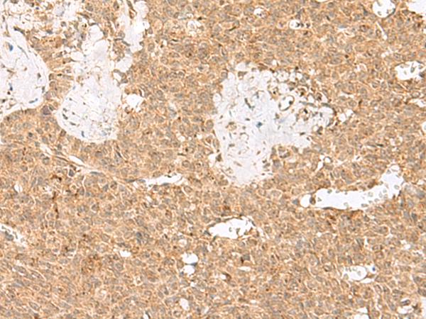 LGALSL / Galectin 5 Antibody - Immunohistochemistry of paraffin-embedded Human ovarian cancer tissue  using LGALSL Polyclonal Antibody at dilution of 1:25(×200)