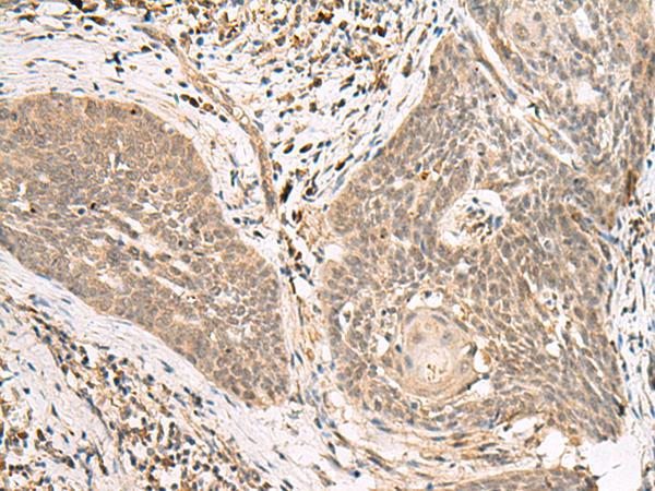 LGALSL / Galectin 5 Antibody - Immunohistochemistry of paraffin-embedded Human esophagus cancer tissue  using LGALSL Polyclonal Antibody at dilution of 1:25(×200)