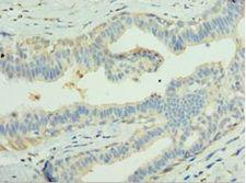 LGI1 Antibody - Immunohistochemistry of paraffin-embedded human breast cancer using antibody at 1:100 dilution.