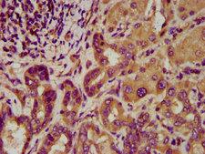 LGI4 Antibody - Immunohistochemistry image at a dilution of 1:200 and staining in paraffin-embedded human liver cancer performed on a Leica BondTM system. After dewaxing and hydration, antigen retrieval was mediated by high pressure in a citrate buffer (pH 6.0) . Section was blocked with 10% normal goat serum 30min at RT. Then primary antibody (1% BSA) was incubated at 4 °C overnight. The primary is detected by a biotinylated secondary antibody and visualized using an HRP conjugated SP system.