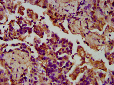 LGI4 Antibody - Immunohistochemistry image at a dilution of 1:200 and staining in paraffin-embedded human lung cancer performed on a Leica BondTM system. After dewaxing and hydration, antigen retrieval was mediated by high pressure in a citrate buffer (pH 6.0) . Section was blocked with 10% normal goat serum 30min at RT. Then primary antibody (1% BSA) was incubated at 4 °C overnight. The primary is detected by a biotinylated secondary antibody and visualized using an HRP conjugated SP system.