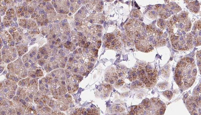 LGTN / EIF2D Antibody - 1:100 staining human pancreas carcinoma tissue by IHC-P. The sample was formaldehyde fixed and a heat mediated antigen retrieval step in citrate buffer was performed. The sample was then blocked and incubated with the antibody for 1.5 hours at 22°C. An HRP conjugated goat anti-rabbit antibody was used as the secondary.