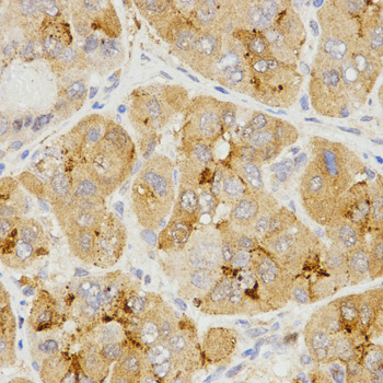 LHB / Luteinizing Hormone Antibody - Immunohistochemistry of paraffin-embedded human liver cancer tissue using LHB antibody at dilution of 1:200 (x400 lens).
