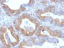 LHCGR / LHR / LH Receptor Antibody - IHC testing of FFPE human ovarian carcinoma with LHR antibody (clone LHCGR/1417). Required HIER: boil tissue sections in 10mM citrate buffer, pH 6, for 10-20 min.