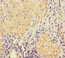 LHFPL1 Antibody - Immunohistochemistry of paraffin-embedded human liver cancer using LHFPL1 Antibody at dilution of 1:100