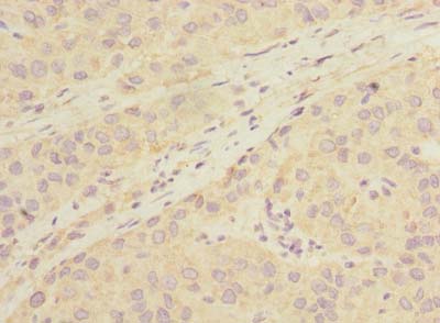 LHPP Antibody - Immunohistochemistry of paraffin-embedded human liver cancer using antibody at dilution of 1:100.