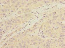 LHPP Antibody - Immunohistochemistry of paraffin-embedded human liver cancer using antibody at dilution of 1:100.