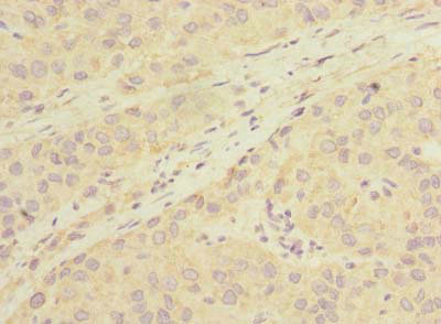 LHPP Antibody - Immunohistochemistry of paraffin-embedded human liver cancer using LHPP Antibody at dilution of 1:100