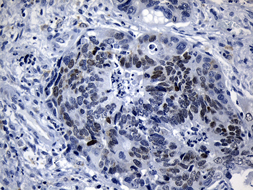 LHX2 Antibody - Immunohistochemical staining of paraffin-embedded Adenocarcinoma of Human colon tissue using anti-LHX2 mouse monoclonal antibody. (Heat-induced epitope retrieval by 1mM EDTA in 10mM Tris buffer. (pH8.5) at 120°C for 3 min. (1:150)