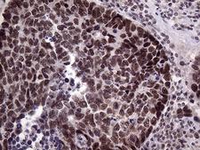 LHX4 Antibody - Immunohistochemical staining of paraffin-embedded Carcinoma of Human lung tissue using anti-LHX4 mouse monoclonal antibody. (Heat-induced epitope retrieval by 1mM EDTA in 10mM Tris buffer. (pH8.5) at 120°C for 3 min. (1:150)