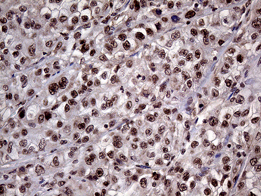 LHX4 Antibody - Immunohistochemical staining of paraffin-embedded Carcinoma of Human kidney tissue using anti-LHX4 mouse monoclonal antibody. (Heat-induced epitope retrieval by 1mM EDTA in 10mM Tris buffer. (pH8.5) at 120°C for 3 min. (1:150)