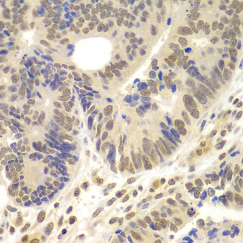 LHX4 Antibody - Immunohistochemistry of paraffin-embedded human colon carcinoma using LHX4 antibody at dilution of 1:100 (x400 lens).