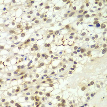LHX4 Antibody - Immunohistochemistry of paraffin-embedded human kidney cancer using LHX4 antibody at dilution of 1:100 (x400 lens).