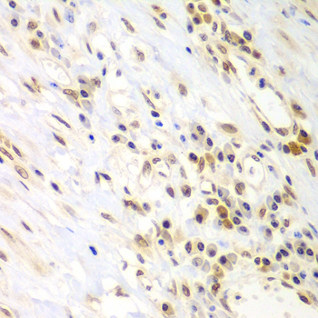 LHX4 Antibody - Immunohistochemistry of paraffin-embedded human gastric cancer using LHX4 antibody at dilution of 1:100 (x400 lens).