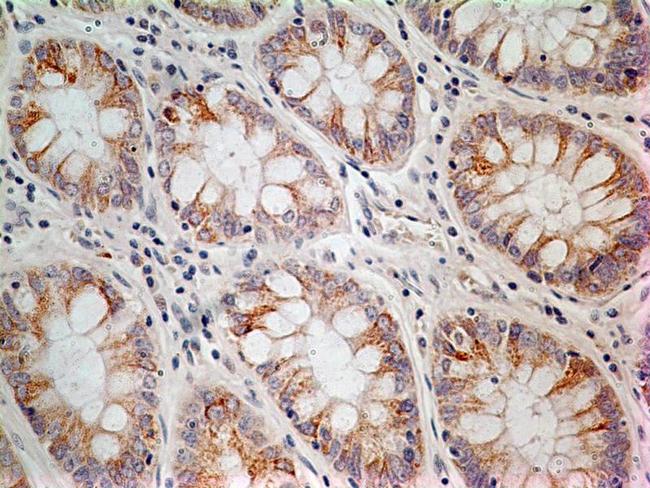 LIF Antibody - Immunohistochemistry-Paraffin: LIF Antibody (39N7D10) - IHC analysis of formalin-fixed paraffin-embedded tissue section of adenocarcinoma of human rectum using 5 ug/ml concentration of LIF antibody (clone 39N7D10). The cancer cells as well as the goblet cells in the rectal glands depicted membrane-cytoplasmic immunostaining of LIF protein.  This image was taken for the unconjugated form of this product. Other forms have not been tested.