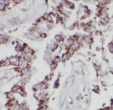 LIF Antibody - Immunohistochemistry of paraffin-embedded human lung cancer tissue slide using LIF antibody at dilution of 1:200