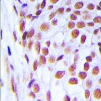 LIG1 / DNA Ligase 1 Antibody - Immunohistochemical analysis of DNA Ligase 1 staining in human breast cancer formalin fixed paraffin embedded tissue section. The section was pre-treated using heat mediated antigen retrieval with sodium citrate buffer (pH 6.0). The section was then incubated with the antibody at room temperature and detected using an HRP polymer system. DAB was used as the chromogen. The section was then counterstained with hematoxylin and mounted with DPX.