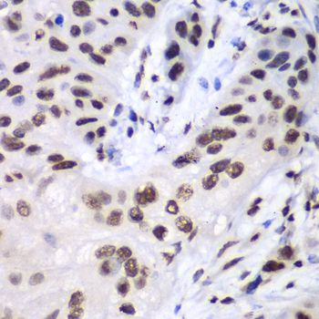 LIG3 / DNA Ligase III Antibody - Immunohistochemistry of paraffin-embedded human esophageal cancer using LIG3 antibody at dilution of 1:100 (40x lens).