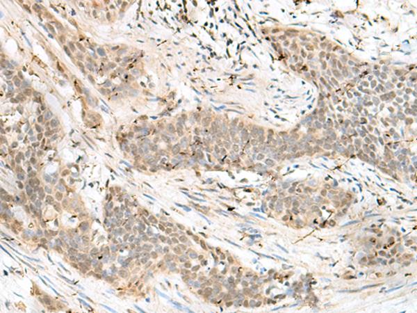 LIG4 / DNA Ligase IV Antibody - Immunohistochemistry of paraffin-embedded Human esophagus cancer tissue  using LIG4 Polyclonal Antibody at dilution of 1:60(×200)