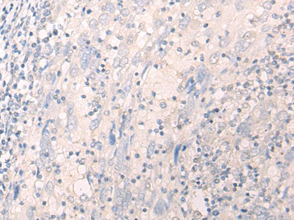 LILRA2 / CD85h / ILT1 Antibody - Immunohistochemistry of paraffin-embedded Human cervical cancer tissue  using LILRA2 Polyclonal Antibody at dilution of 1:40(×200)