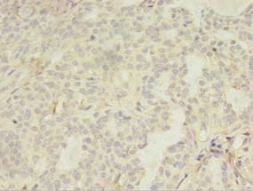 LILRA4 / ILT7 Antibody - Immunohistochemistry of paraffin-embedded human breast cancer tissue using antibody at 1:100 dilution.