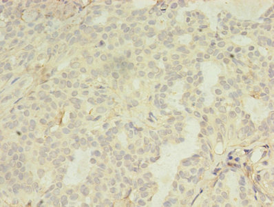 LILRA4 / ILT7 Antibody - Immunohistochemistry of paraffin-embedded human breast cancer using LILRA4 Antibody at dilution of 1:100
