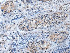 LILRB5 / LIR8 Antibody - Immunohistochemistry of paraffin-embedded Human cervical cancer tissue  using LILRB5 Polyclonal Antibody at dilution of 1:25(×200)