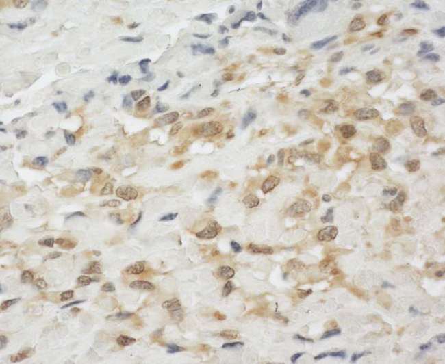 LIM Protein / LPP Antibody - Detection of Human LPP by Immunohistochemistry. Sample: FFPE section of human osteosarcoma. Antibody: Affinity purified rabbit anti-LPP used at a dilution of 1:200 (1 Detection: DAB.