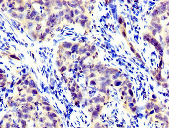 LIM Protein / LPP Antibody - Immunohistochemistry image at a dilution of 1:300 and staining in paraffin-embedded human pancreatic cancer performed on a Leica BondTM system. After dewaxing and hydration, antigen retrieval was mediated by high pressure in a citrate buffer (pH 6.0) . Section was blocked with 10% normal goat serum 30min at RT. Then primary antibody (1% BSA) was incubated at 4 °C overnight. The primary is detected by a biotinylated secondary antibody and visualized using an HRP conjugated SP system.