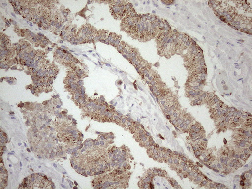 LIME1 / LIME Antibody - Immunohistochemical staining of paraffin-embedded Carcinoma of Human prostate tissue using anti-LIME1 mouse monoclonal antibody. (Heat-induced epitope retrieval by 1mM EDTA in 10mM Tris buffer. (pH8.5) at 120 oC for 3 min. (1:150)