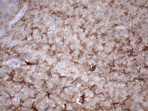 LIME1 / LIME Antibody - Immunohistochemical staining of paraffin-embedded Human lymphoma tissue using anti-LIME1 mouse monoclonal antibody. (Heat-induced epitope retrieval by 1mM EDTA in 10mM Tris buffer. (pH8.5) at 120 oC for 3 min. (1:150)