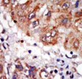 LIMK1 / LIMK Antibody - Formalin-fixed and paraffin-embedded human cancer tissue reacted with the primary antibody, which was peroxidase-conjugated to the secondary antibody, followed by DAB staining. This data demonstrates the use of this antibody for immunohistochemistry; clinical relevance has not been evaluated. BC = breast carcinoma; HC = hepatocarcinoma.