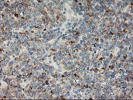 LIMK1 / LIMK Antibody - IHC of paraffin-embedded Human lymphoma tissue using anti-LIMK1 mouse monoclonal antibody.