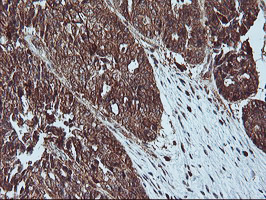 LIMK1 / LIMK Antibody - IHC of paraffin-embedded Adenocarcinoma of Human ovary tissue using anti-LIMK1 mouse monoclonal antibody.