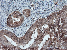 LIMK1 / LIMK Antibody - IHC of paraffin-embedded Adenocarcinoma of Human endometrium tissue using anti-LIMK1 mouse monoclonal antibody.