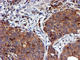 LIMK1 / LIMK Antibody - IHC of paraffin-embedded Carcinoma of Human lung tissue using anti-LIMK1 mouse monoclonal antibody.