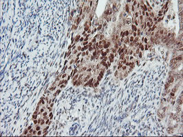 LIMK1 / LIMK Antibody - IHC of paraffin-embedded Adenocarcinoma of Human endometrium tissue using anti-LIMK1 mouse monoclonal antibody.