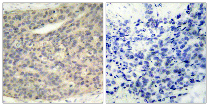 LIMK1 / LIMK Antibody - Immunohistochemistry analysis of paraffin-embedded human breast carcinoma, using LIMK1 (Phospho-Thr508) Antibody. The picture on the right is blocked with the phospho peptide.