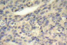 LIMK1 / LIMK Antibody - IHC of p-LIMK1 (T508) pAb in paraffin-embedded human breast carcinoma tissue.