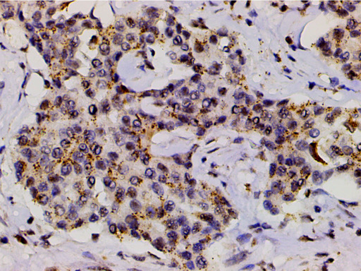 LIMK1 / LIMK Antibody - 1:200 staining human liver carcinoma tissues by IHC-P. The tissue was formaldehyde fixed and a heat mediated antigen retrieval step in citrate buffer was performed. The tissue was then blocked and incubated with the antibody for 1.5 hours at 22°C. An HRP conjugated goat anti-rabbit antibody was used as the secondary.