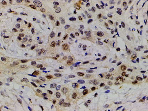 LIMK1 / LIMK Antibody - 1:200 staining human esophageal carcinoma tissue by IHC-P. The tissue was formaldehyde fixed and a heat mediated antigen retrieval step in citrate buffer was performed. The tissue was then blocked and incubated with the antibody for 1.5 hours at 22°C. An HRP conjugated goat anti-rabbit antibody was used as the secondary.